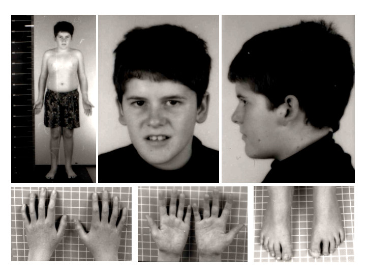 Photo of a child with Prader–Willi syndrome