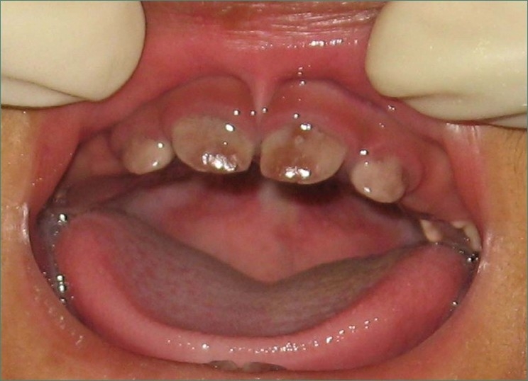 Congenital erythropoietic porphyria