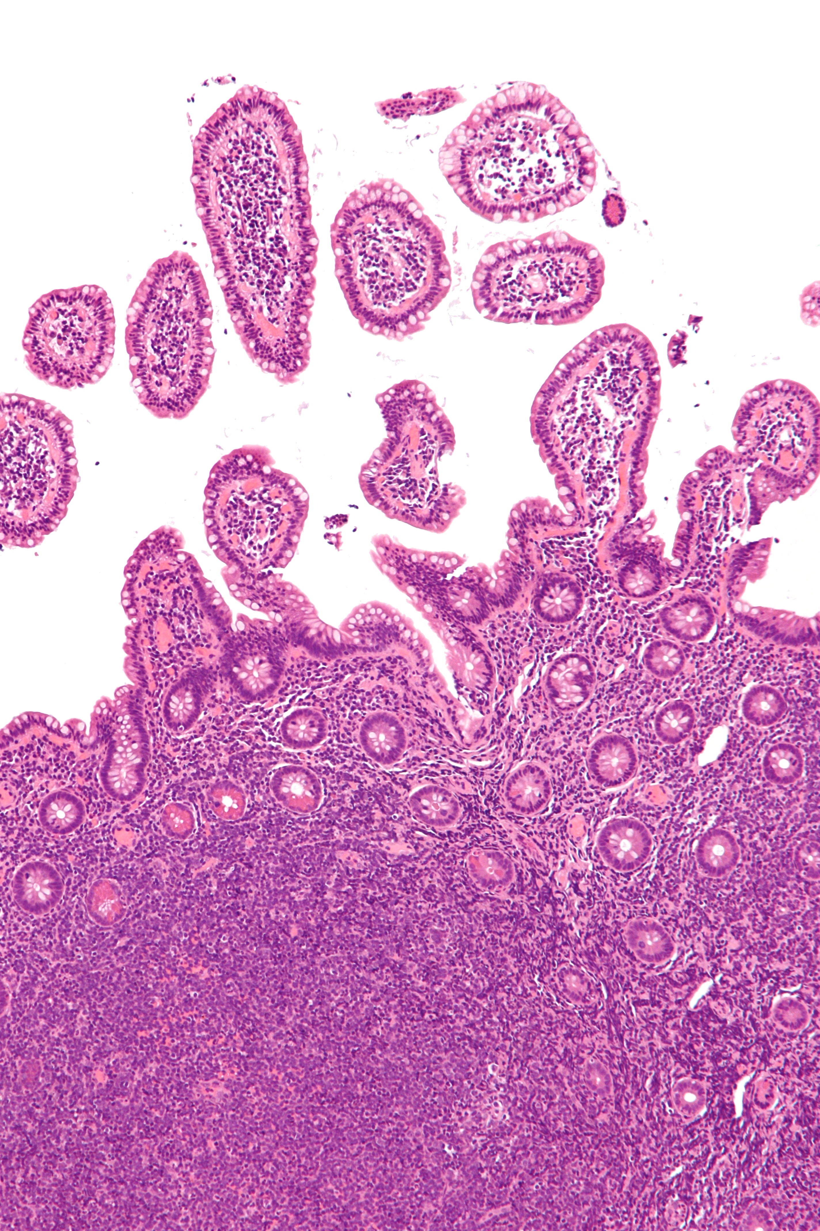 Micrograph of mantle cell lymphoma, a type of non-Hodgkin lymphoma