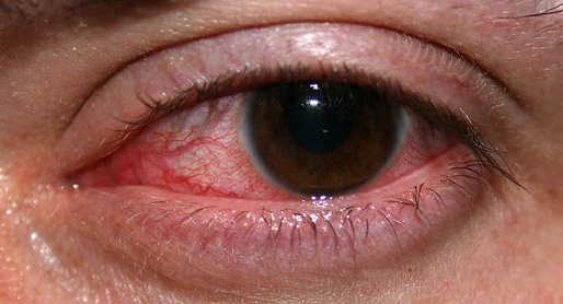 Photophobia