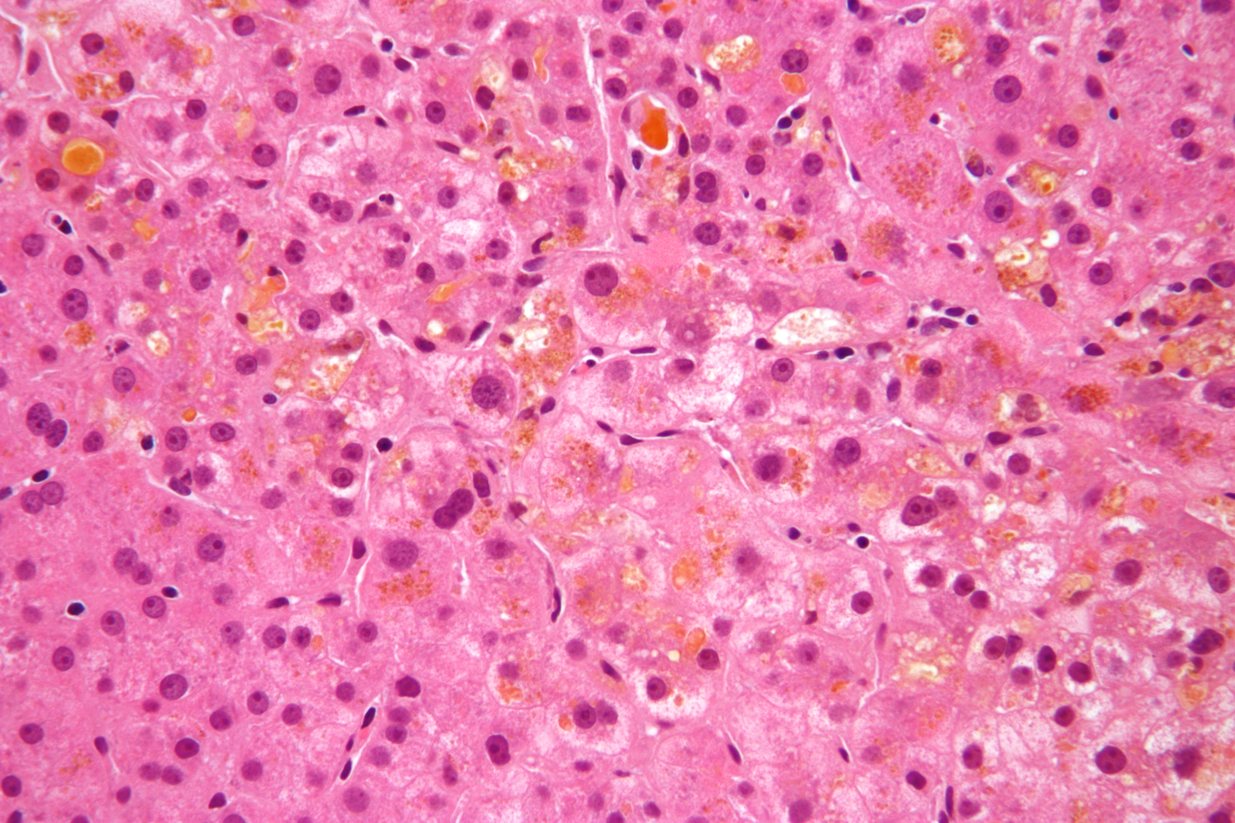Micrograph of cholestasis