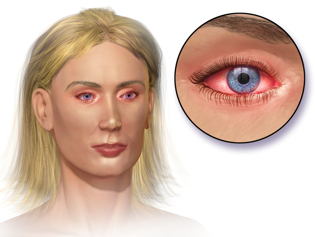 Illustration of allergic conjunctivitis