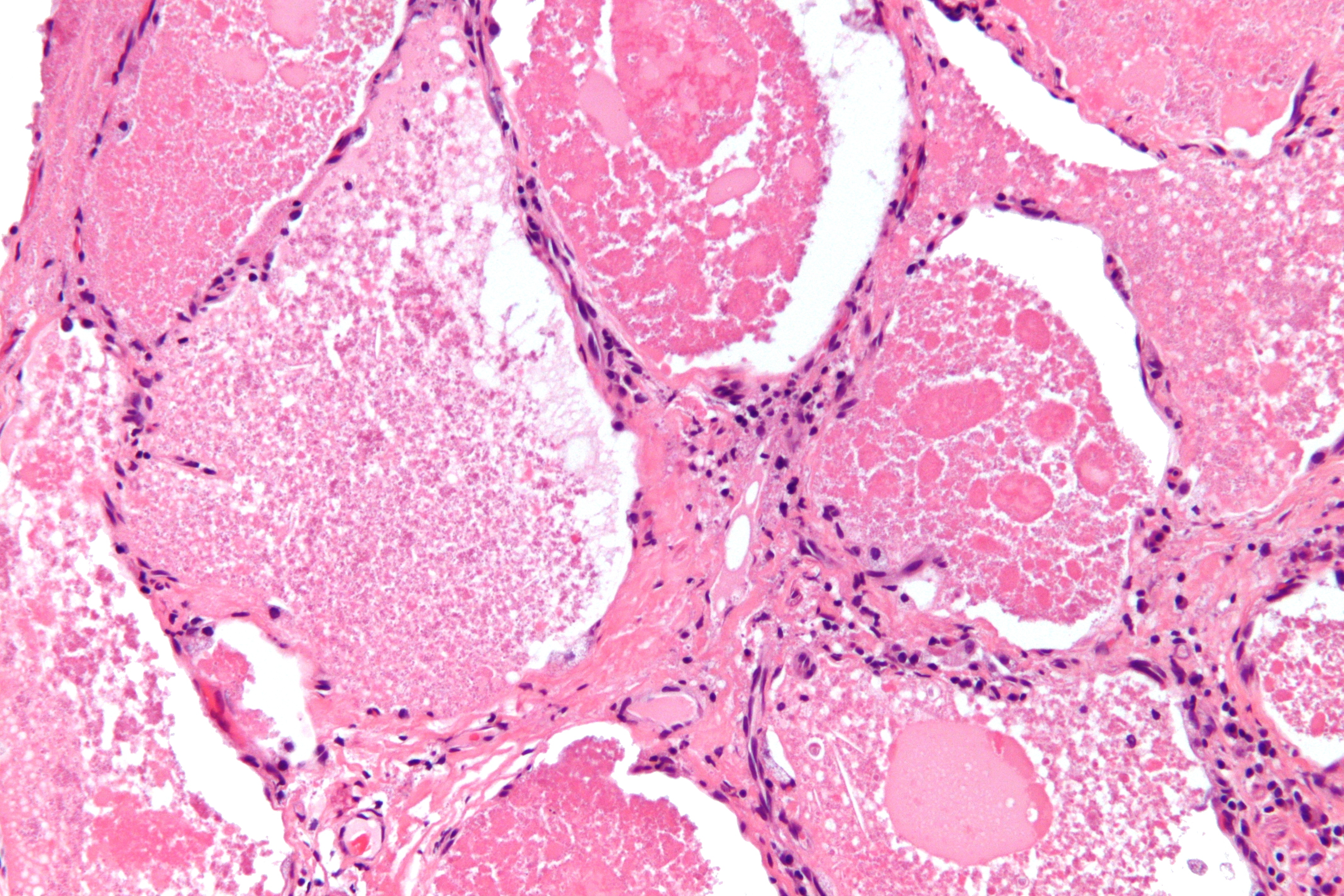 Micrograph of pulmonary alveolar proteinosis