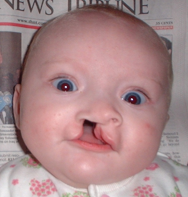 Preoperative image of a patient with Malpuech facial clefting syndrome