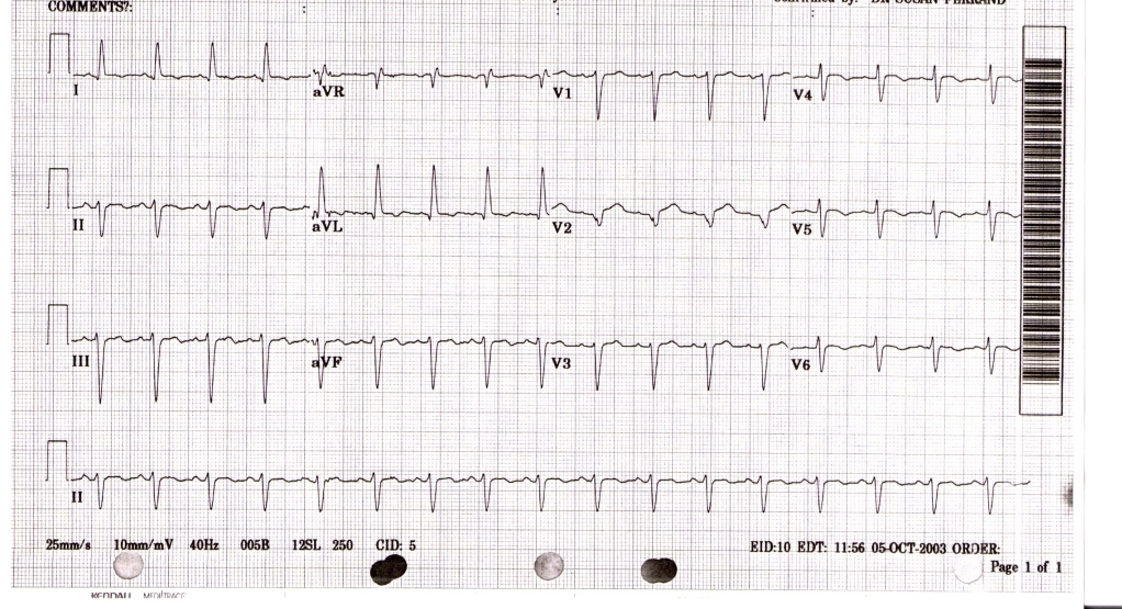 Takotsubo cardiomyopathy