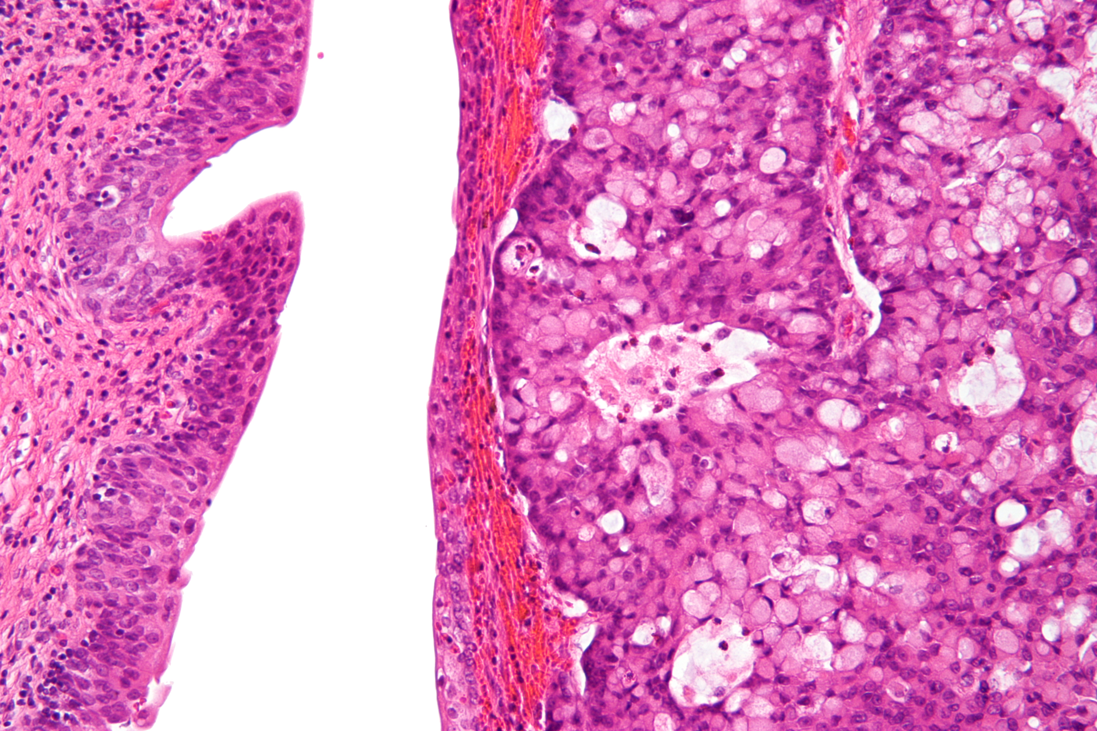 Micrograph of urachal carcinoma