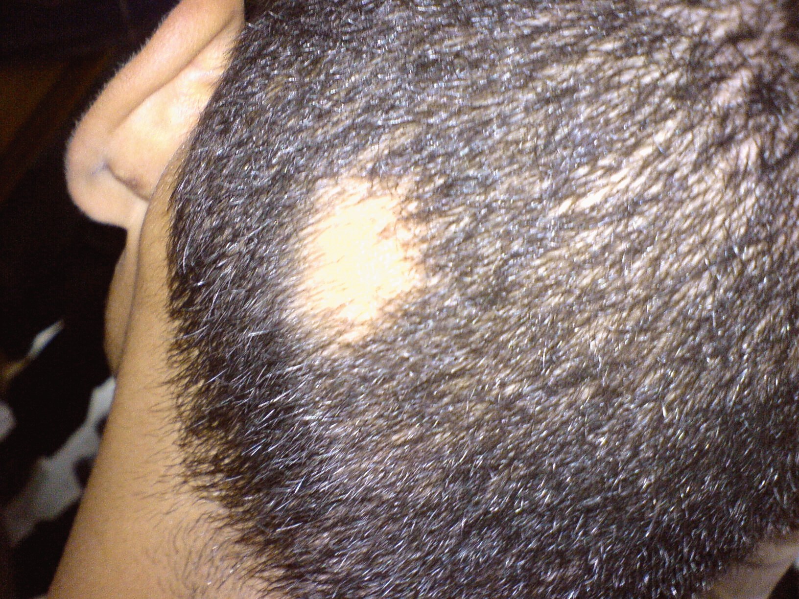 Image of a person with alopecia areata