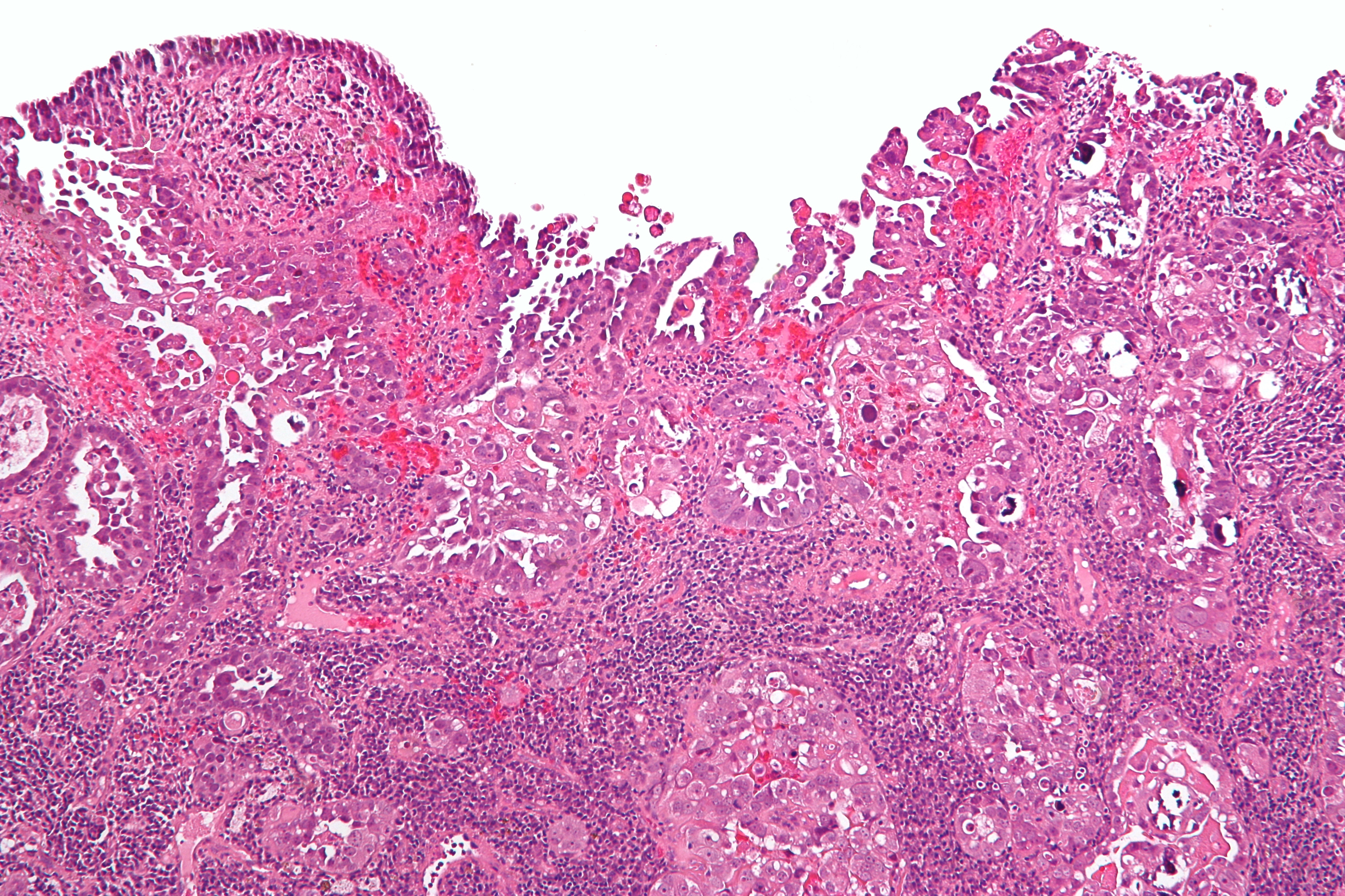 Micrograph of uterine serous carcinoma