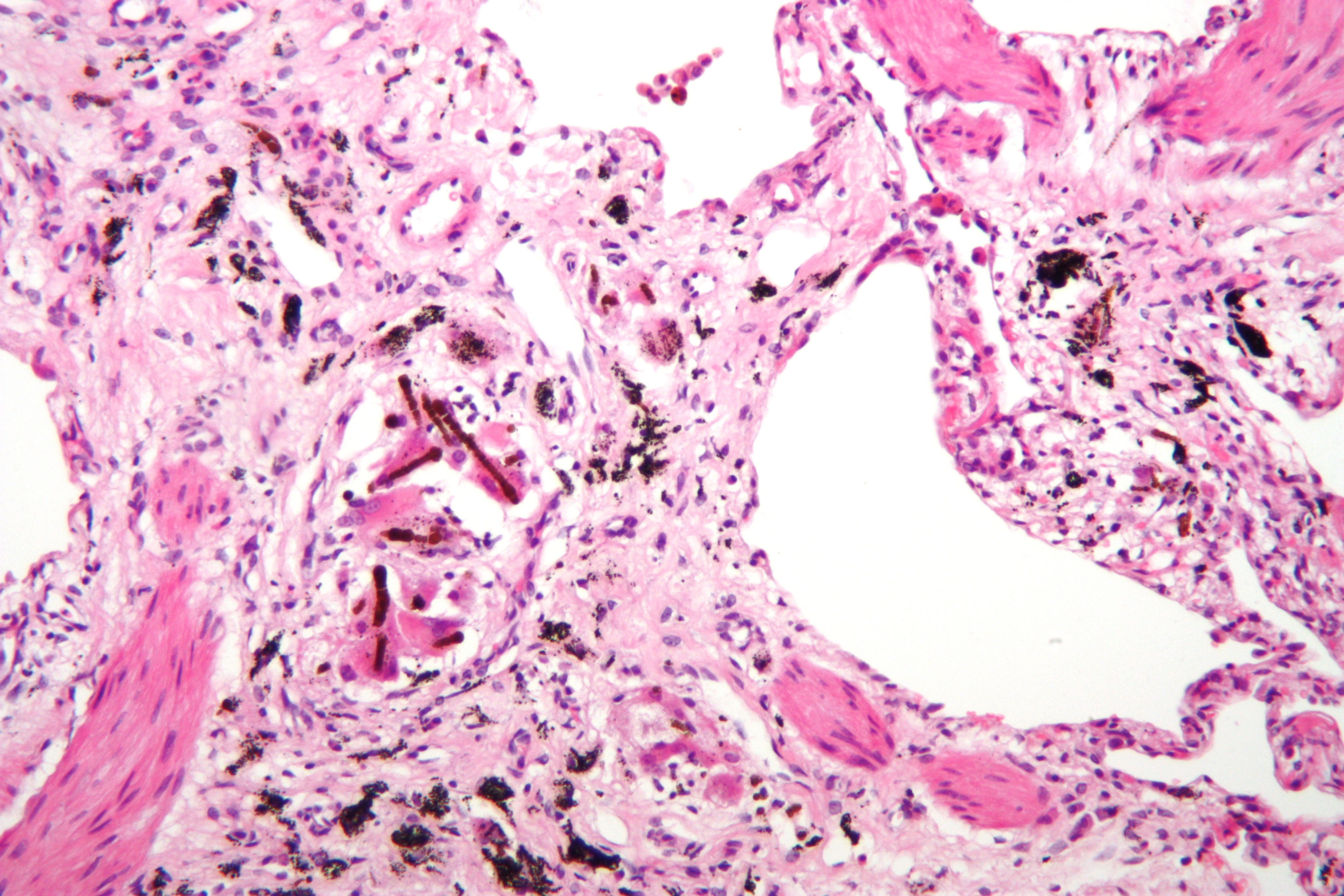 Micrograph of asbestosis