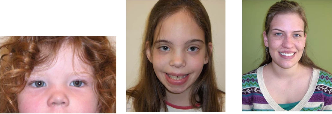 Facial phenotypes of individuals with Trisomy X