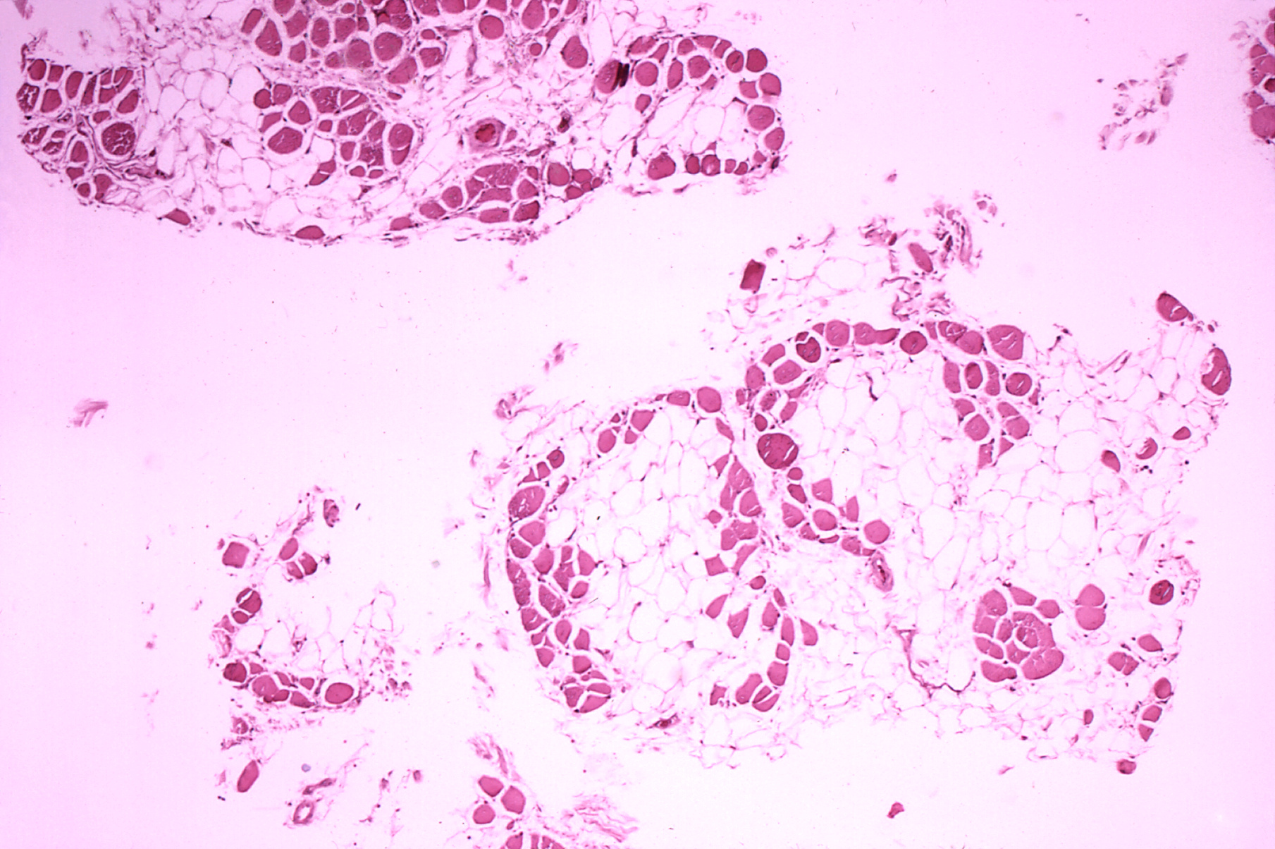 Image of a child with Duchenne muscular dystrophy
