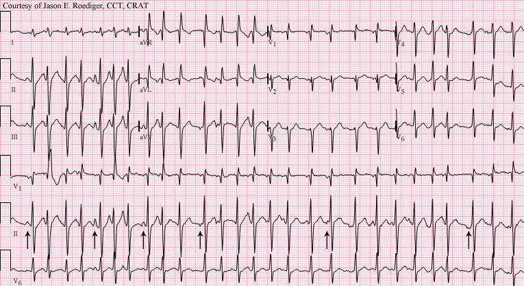 Multifocal_atrial_tachycardia_-_MAT