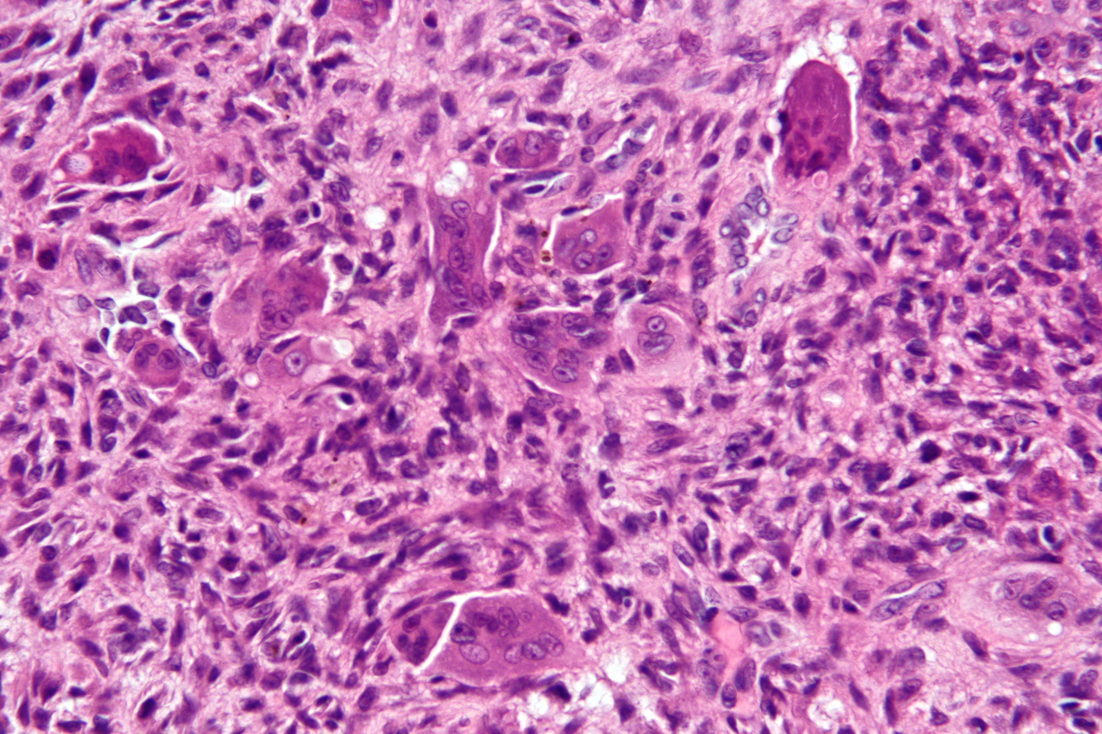 Micrograph of an aneurysmal bone cyst