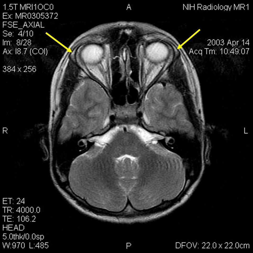 Image of a patient with Triple-A syndrome