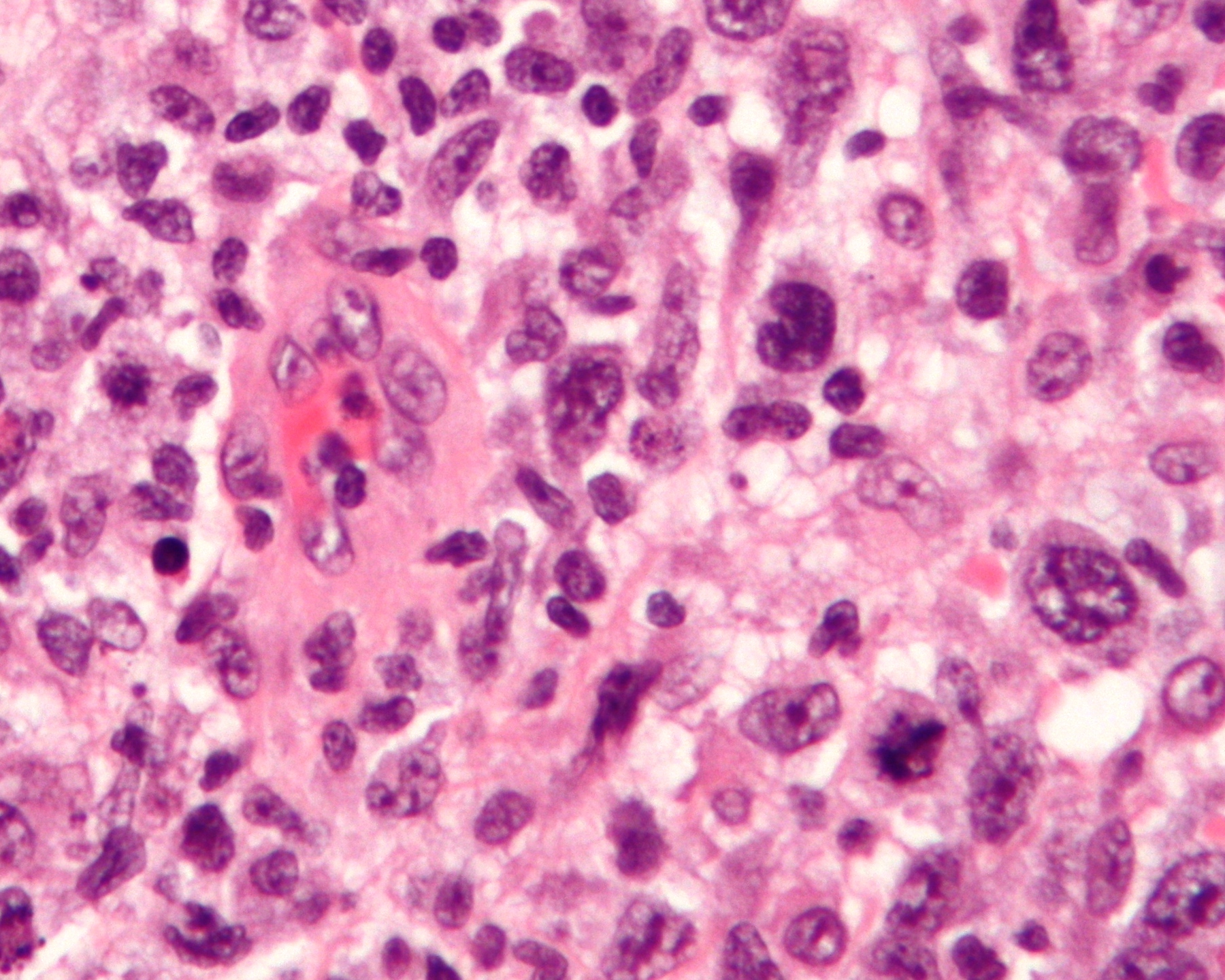 Micrograph of anaplastic large-cell lymphoma
