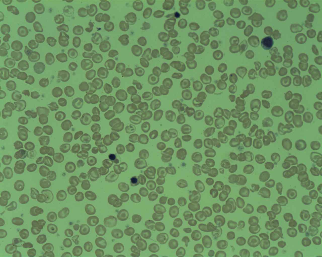 Delta-beta thalassemia