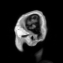 Parasagittal MRI of human head in patient with benign familial macrocephaly prior to brain injury