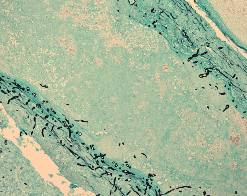 Fungal meningitis in the brain
