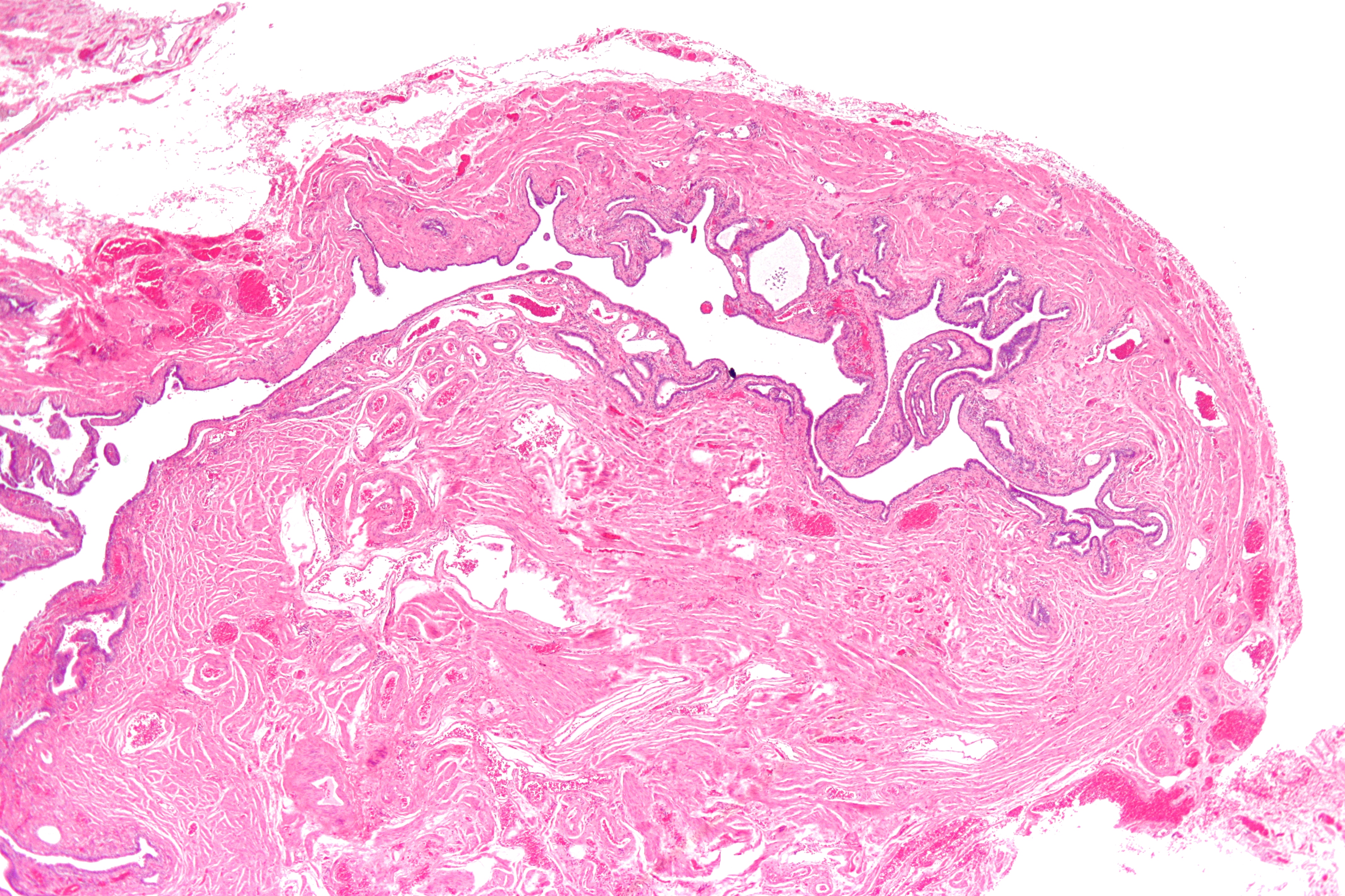 Micrograph of salpingitis isthmica nodosa