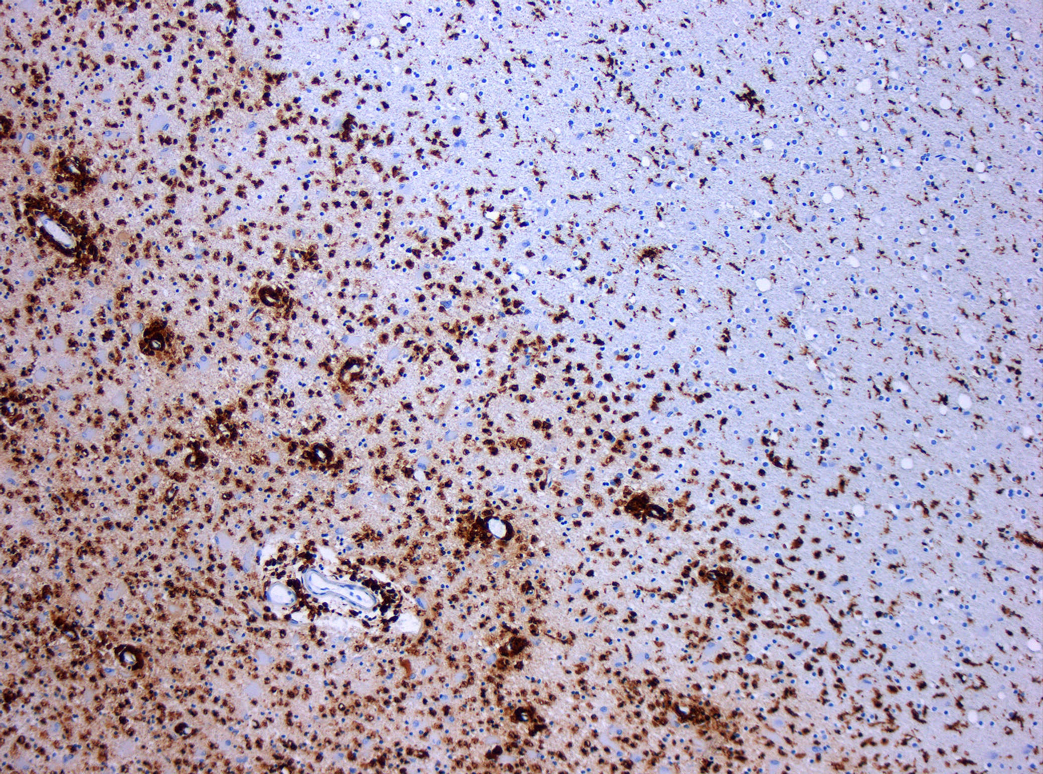 Micrograph showing demyelination in multiple sclerosis. CD68 immunostain.