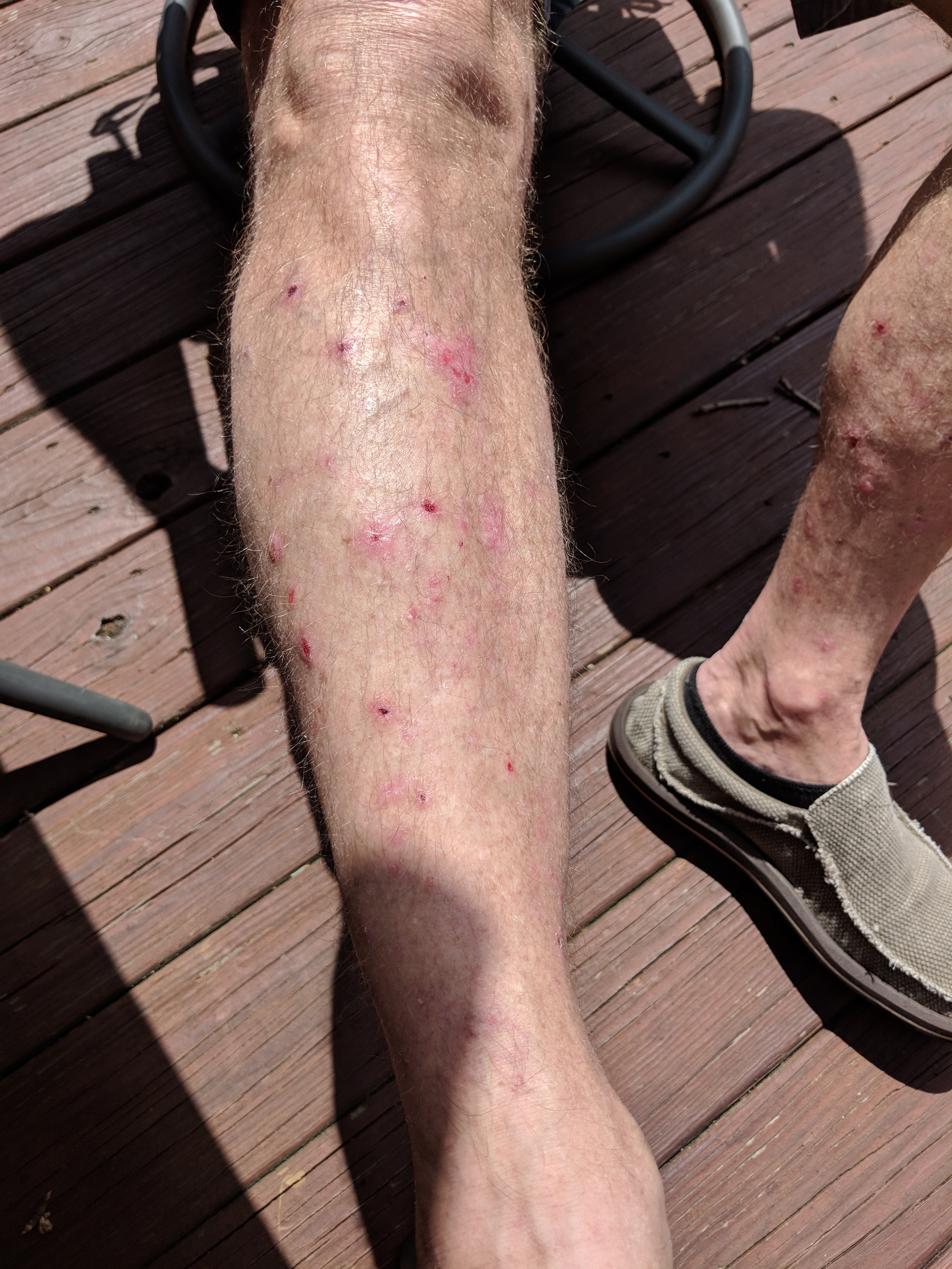 Legs with bullous pemphigoid