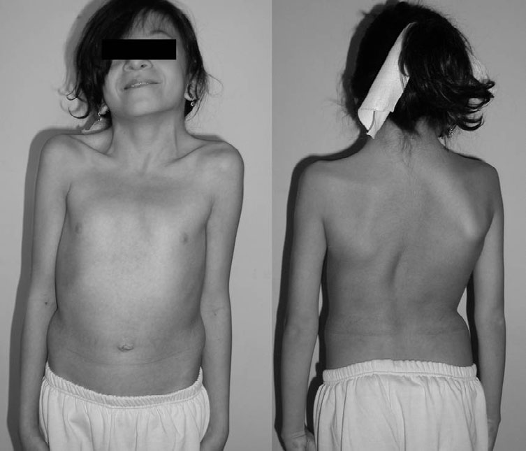 Image of a person with Noonan syndrome