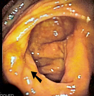Ileocecal valve