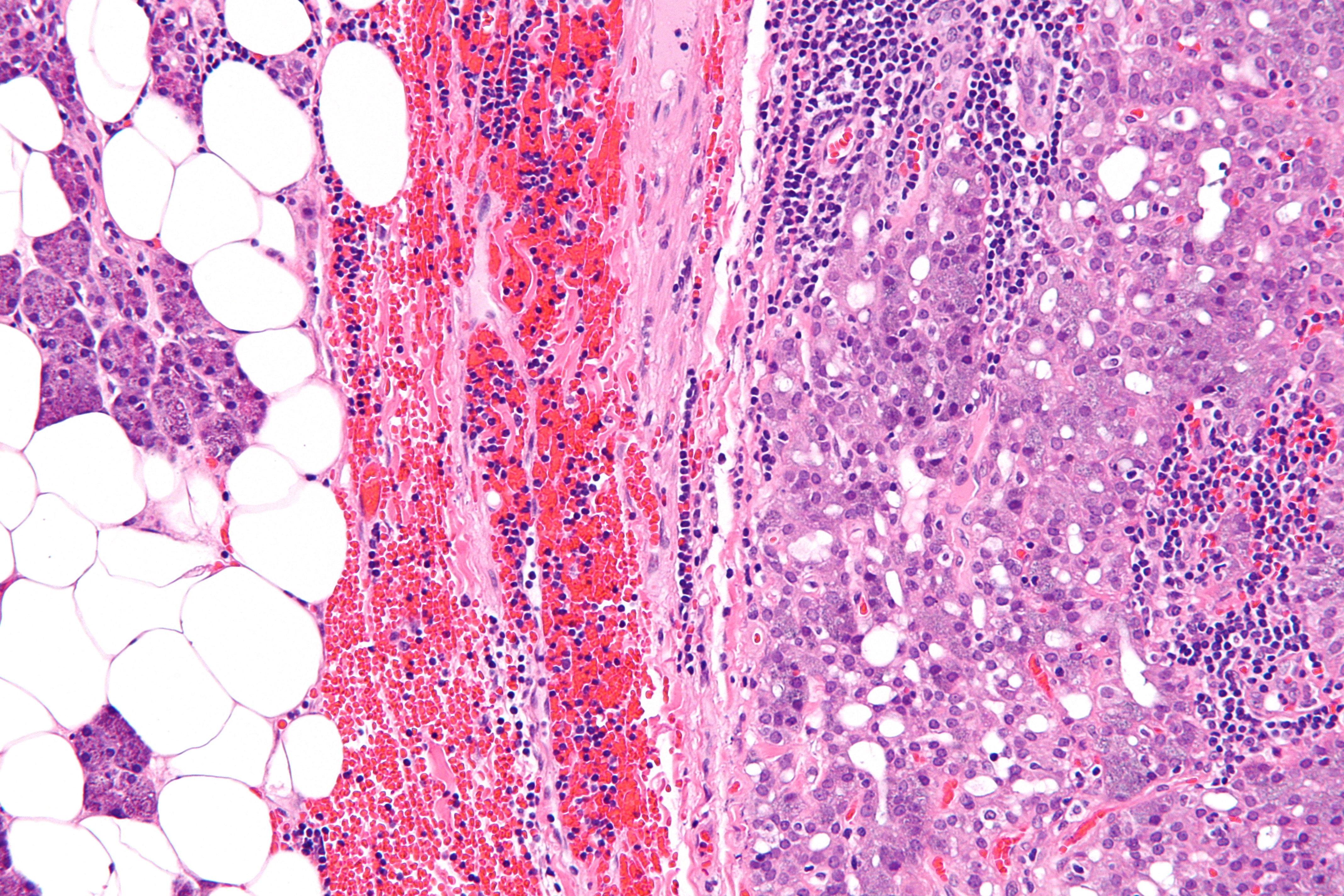 Micrograph of acinic cell carcinoma, high magnification
