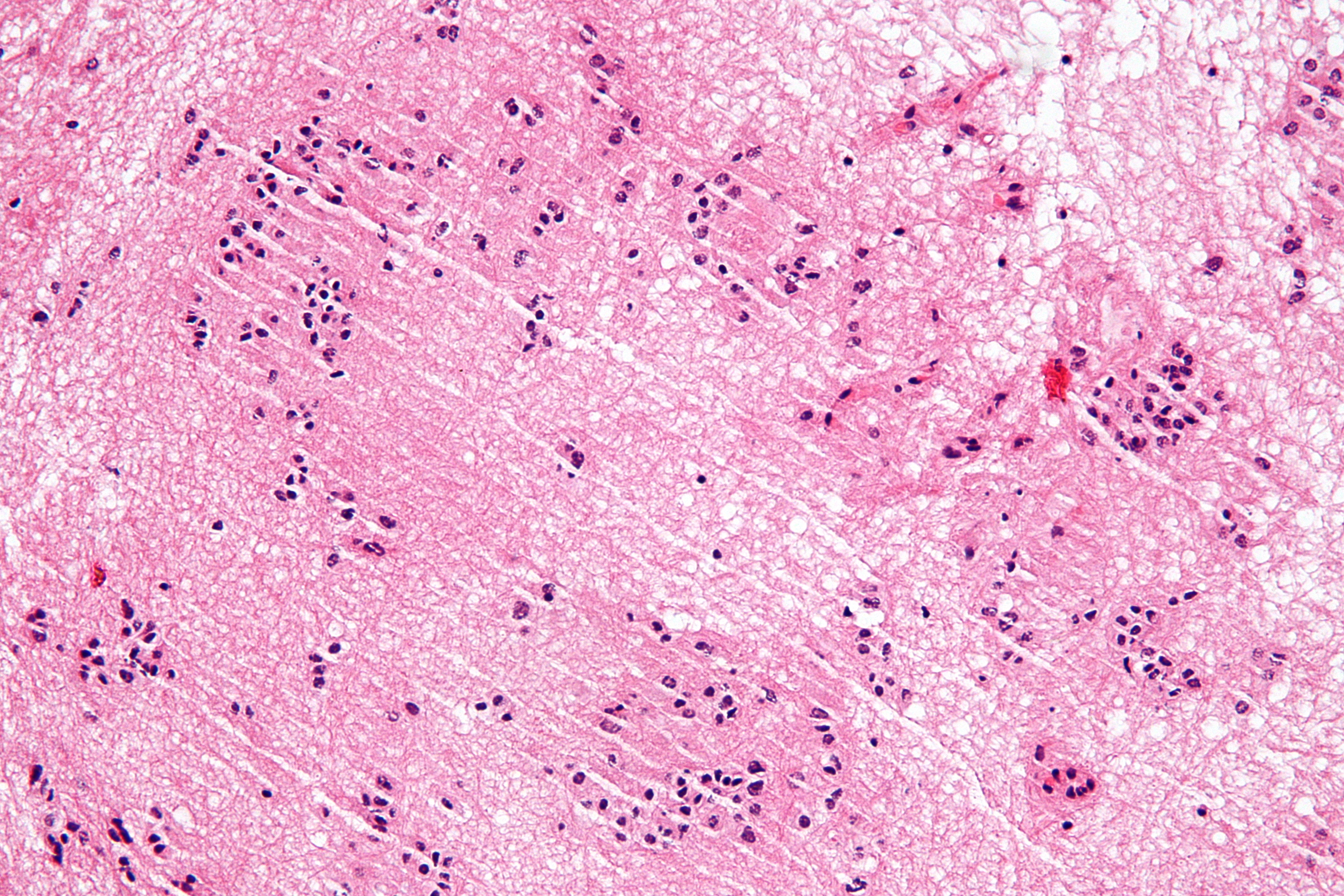 Subependymoma under high magnification
