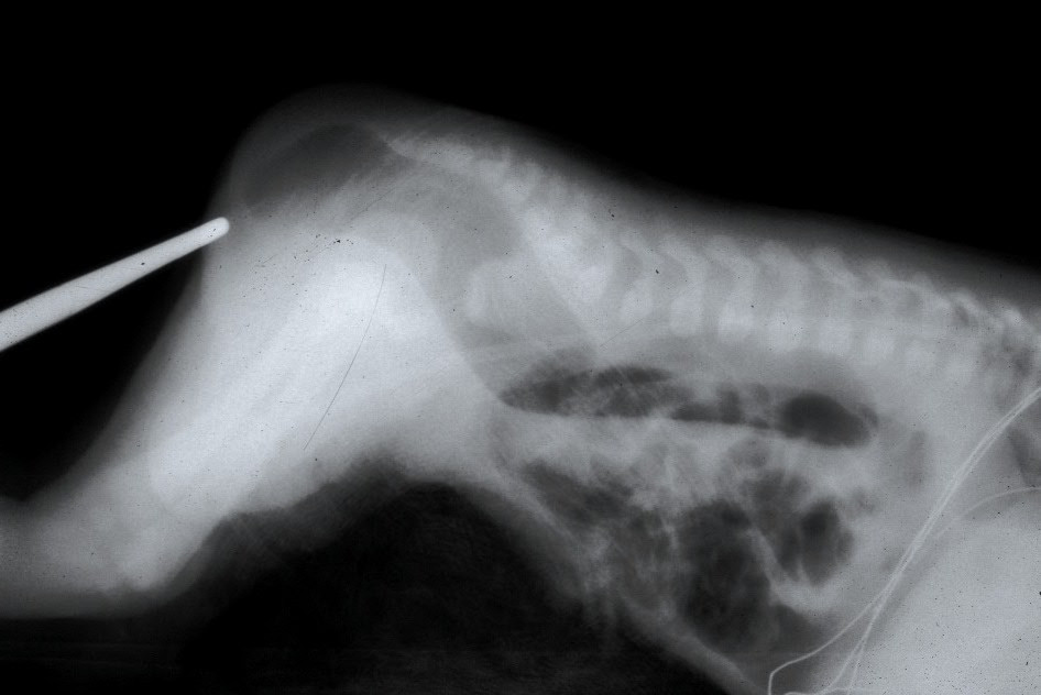 Diagram showing imperforate anus