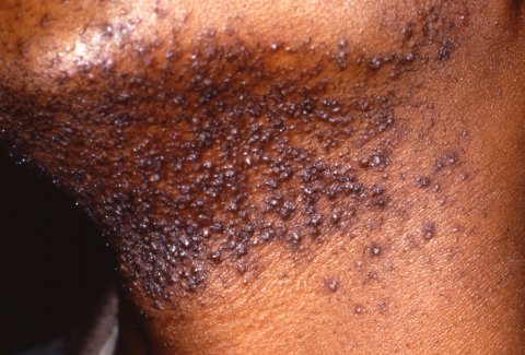 Close-up of skin with pseudofolliculitis barbae