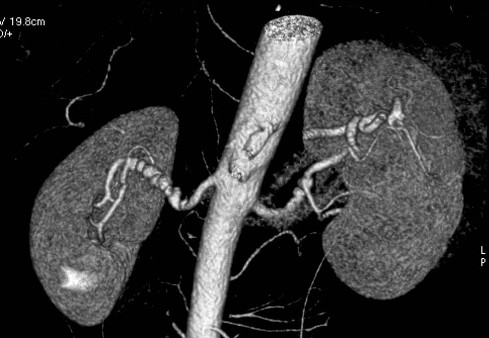 CT angiography showing fibromuscular dysplasia