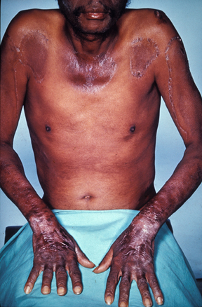 Image showing skin lesions typical of pellagra