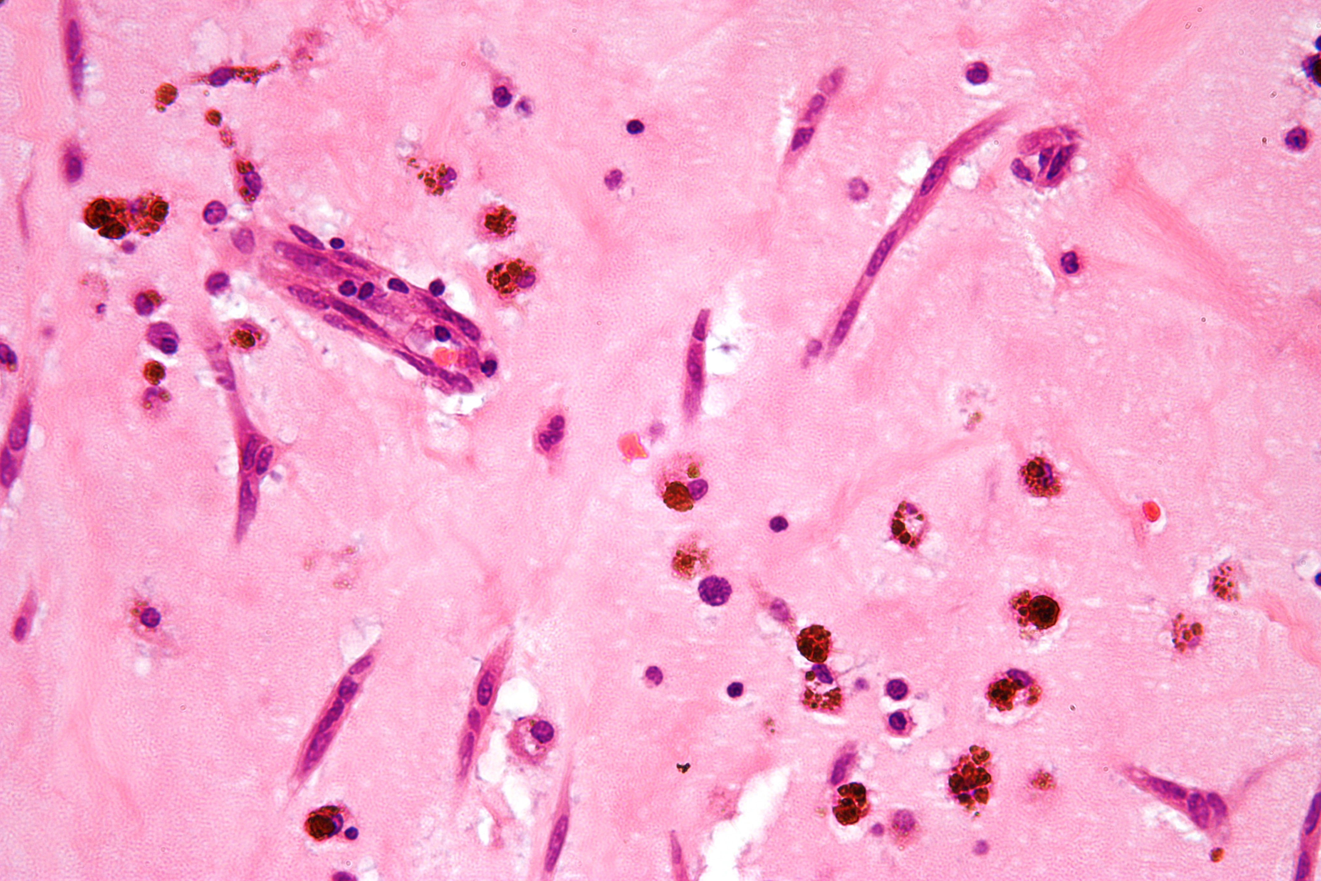 High magnification micrograph of an atrial myxoma