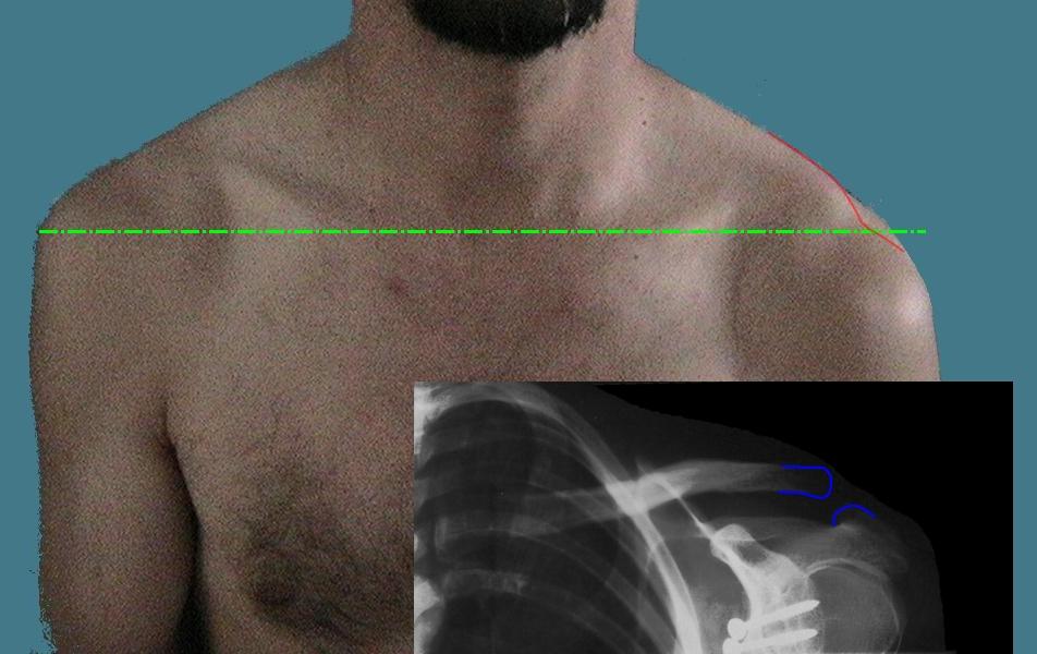 Luxation acromioclaviculaire