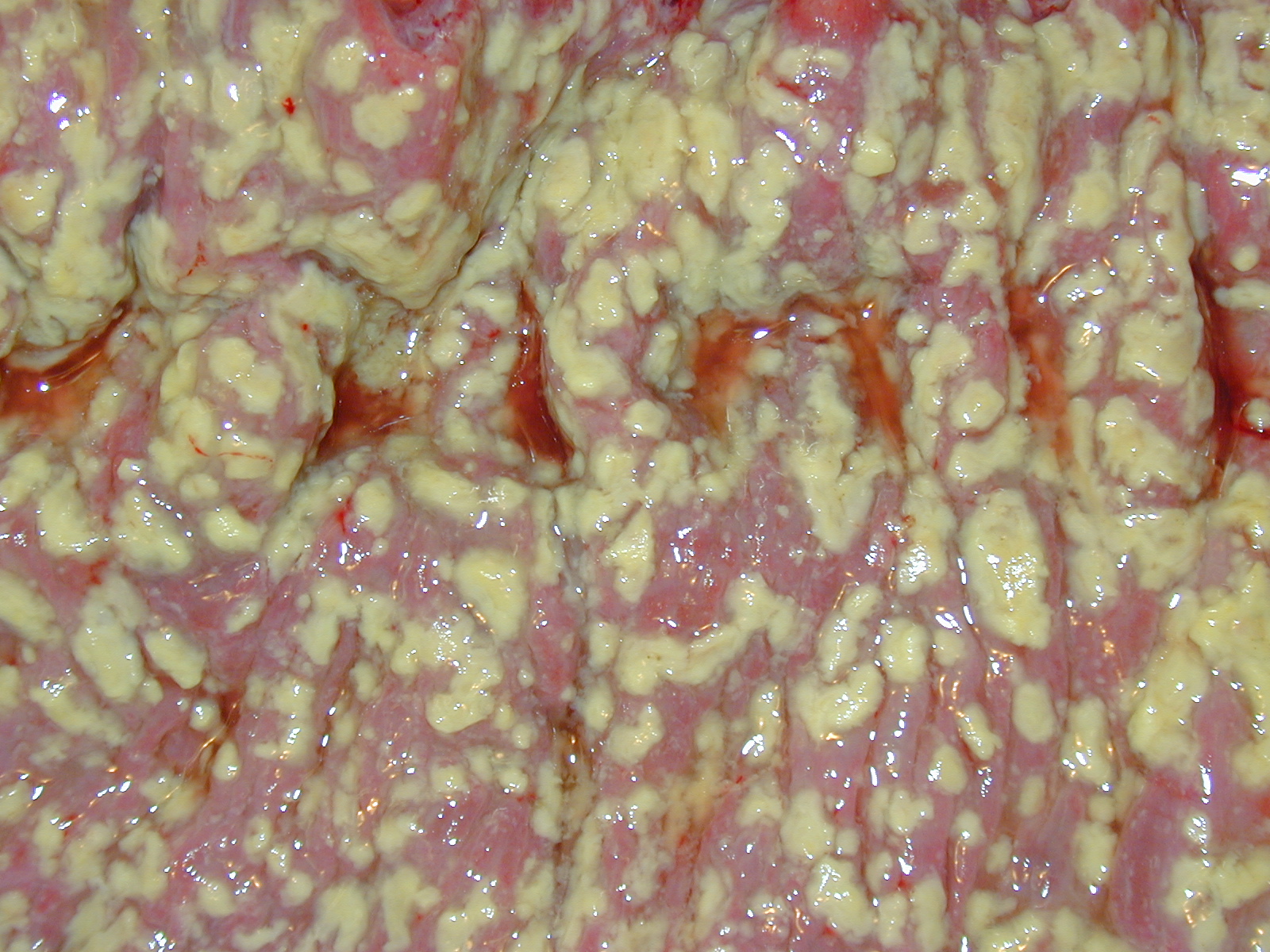 Colonic pseudomembranes in C. difficile infection