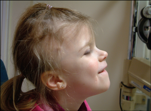 Image showing alopecia in Gómez–López-Hernández syndrome