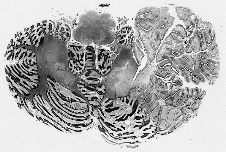 Image of a brain MRI showing Lhermitte–Duclos disease