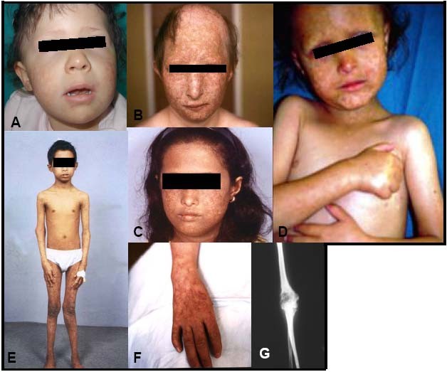 Rothmund–Thomson syndrome