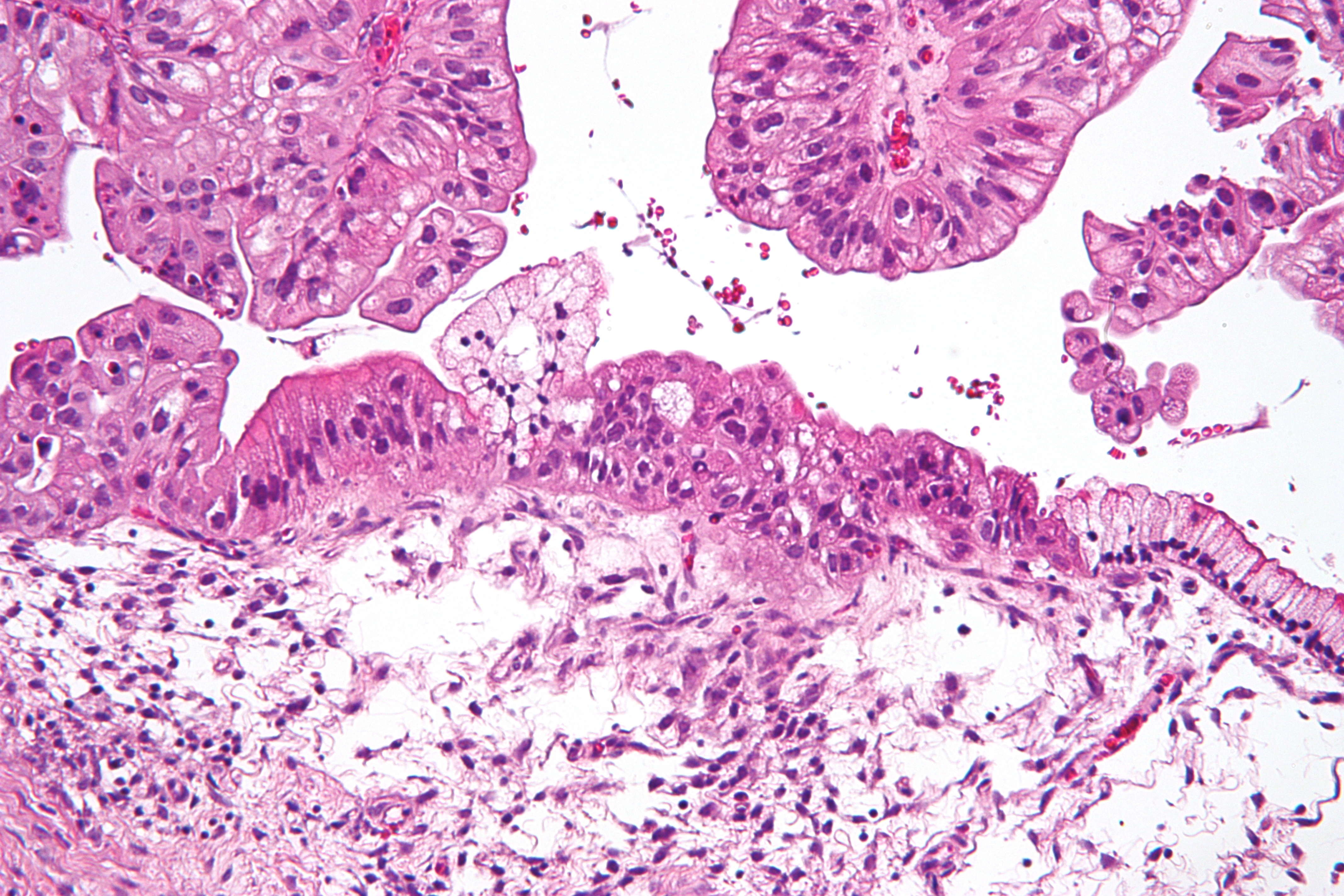 Micrograph of a mucinous cystadenocarcinoma