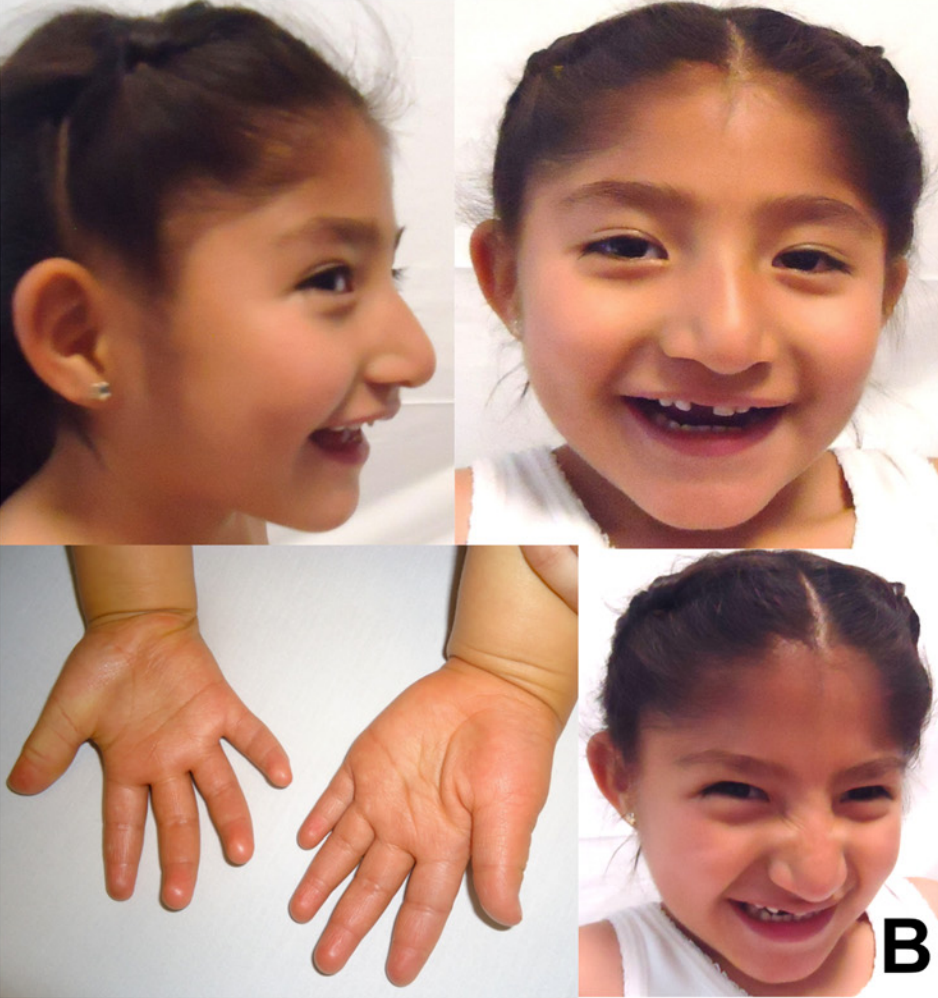 5-year-old Mexican girl with Angelman syndrome