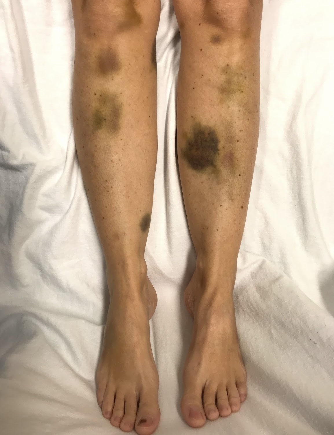 Echymosis