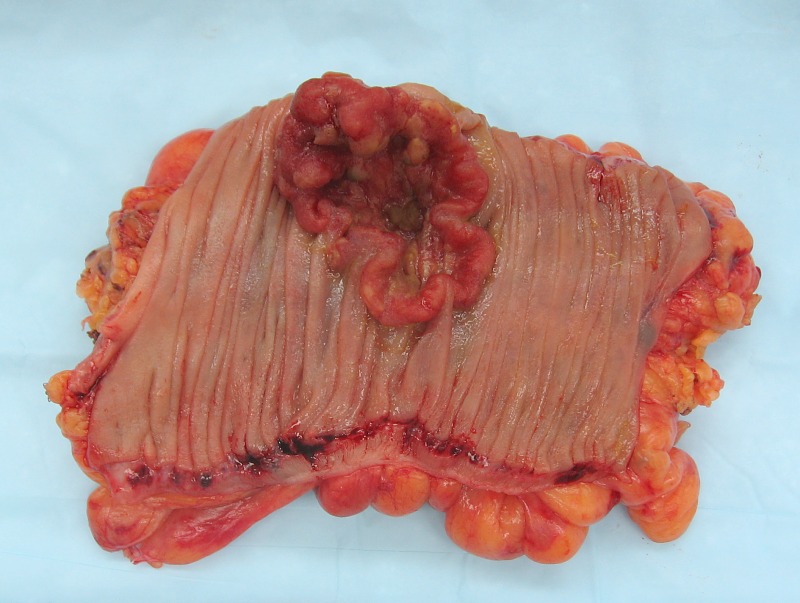 Colon cancer