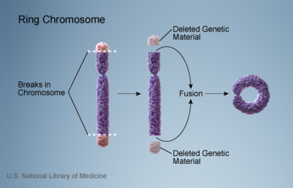 Ring chromosome 15