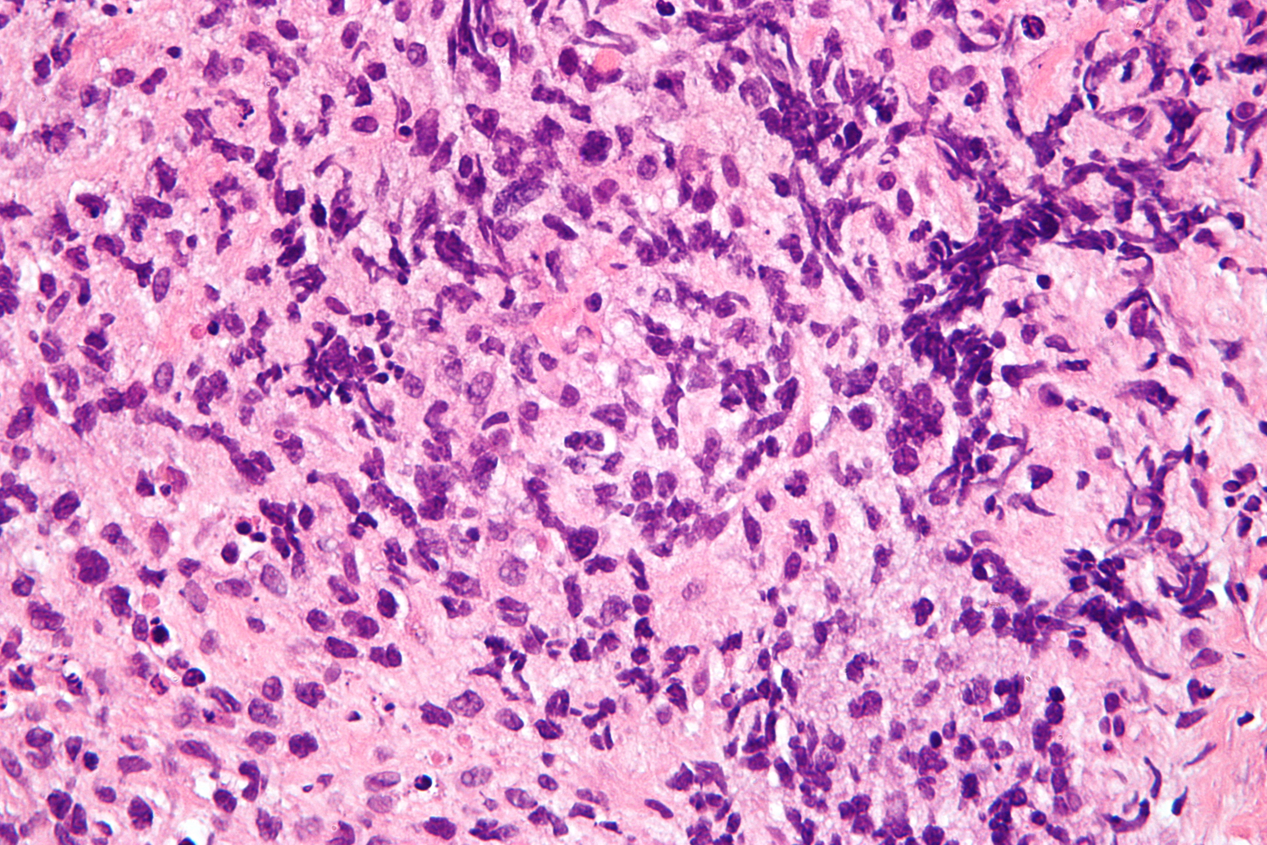 Micrograph of primary mediastinal large B-cell lymphoma