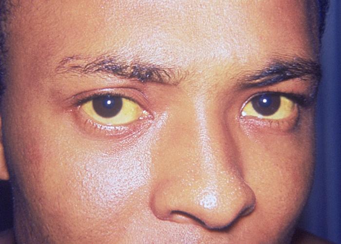 Jaundice eye