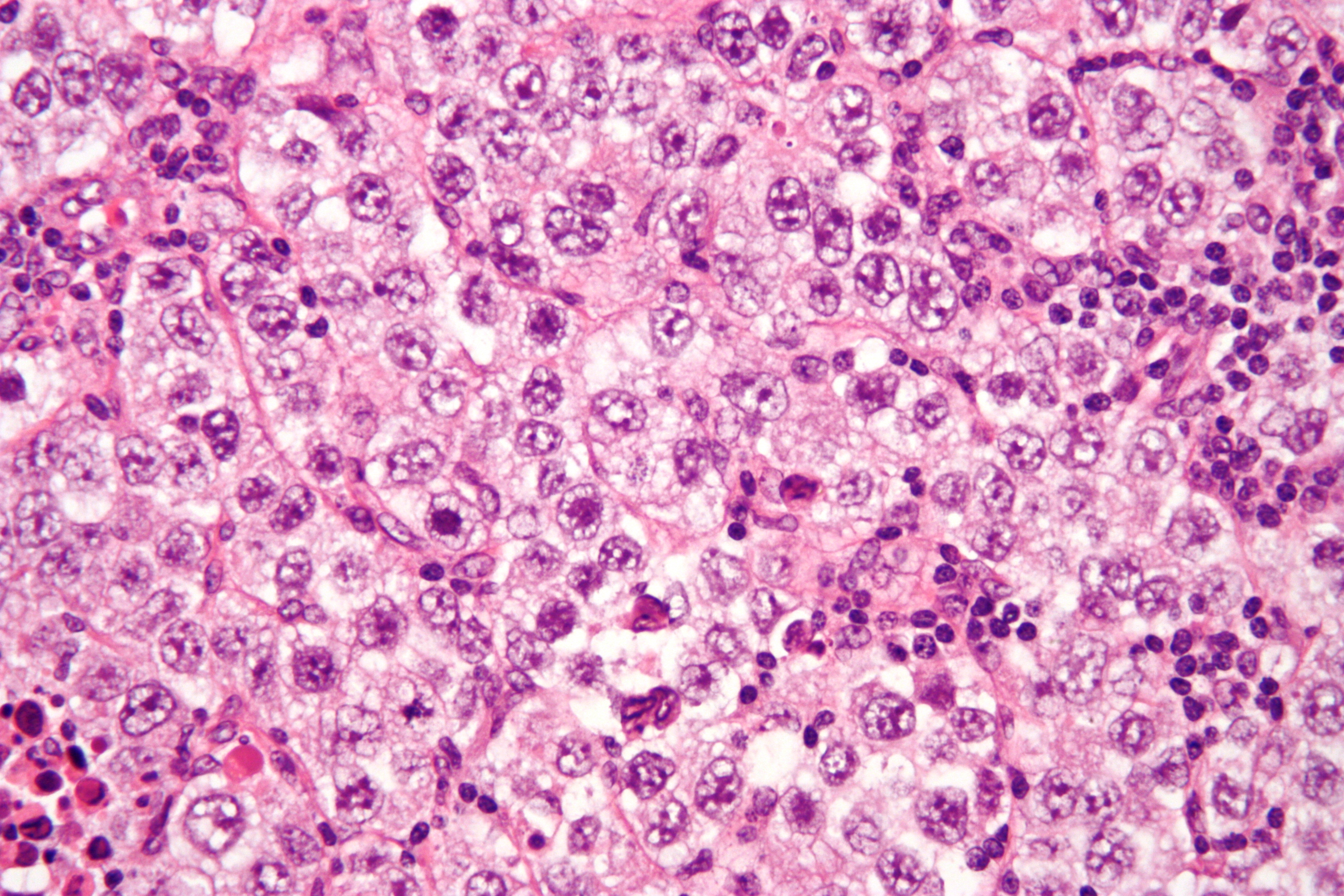 Micrograph of a seminoma, a type of germ cell tumor