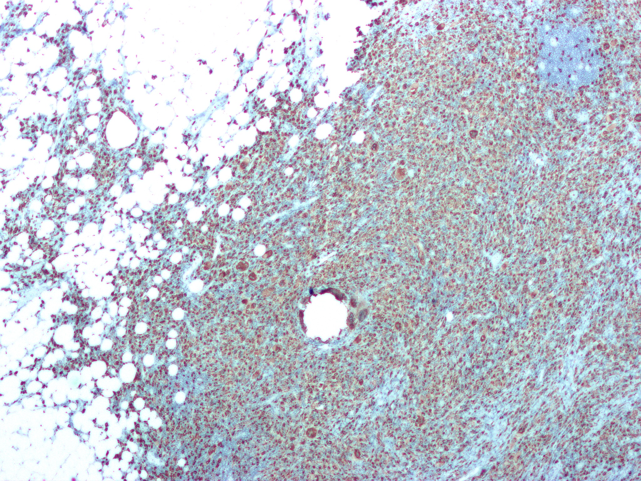 Micrograph of xanthogranulomatous pyelonephritis