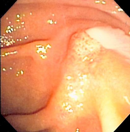 Cholangitis