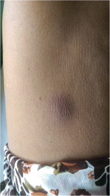 Melioidosis abscess on the abdomen